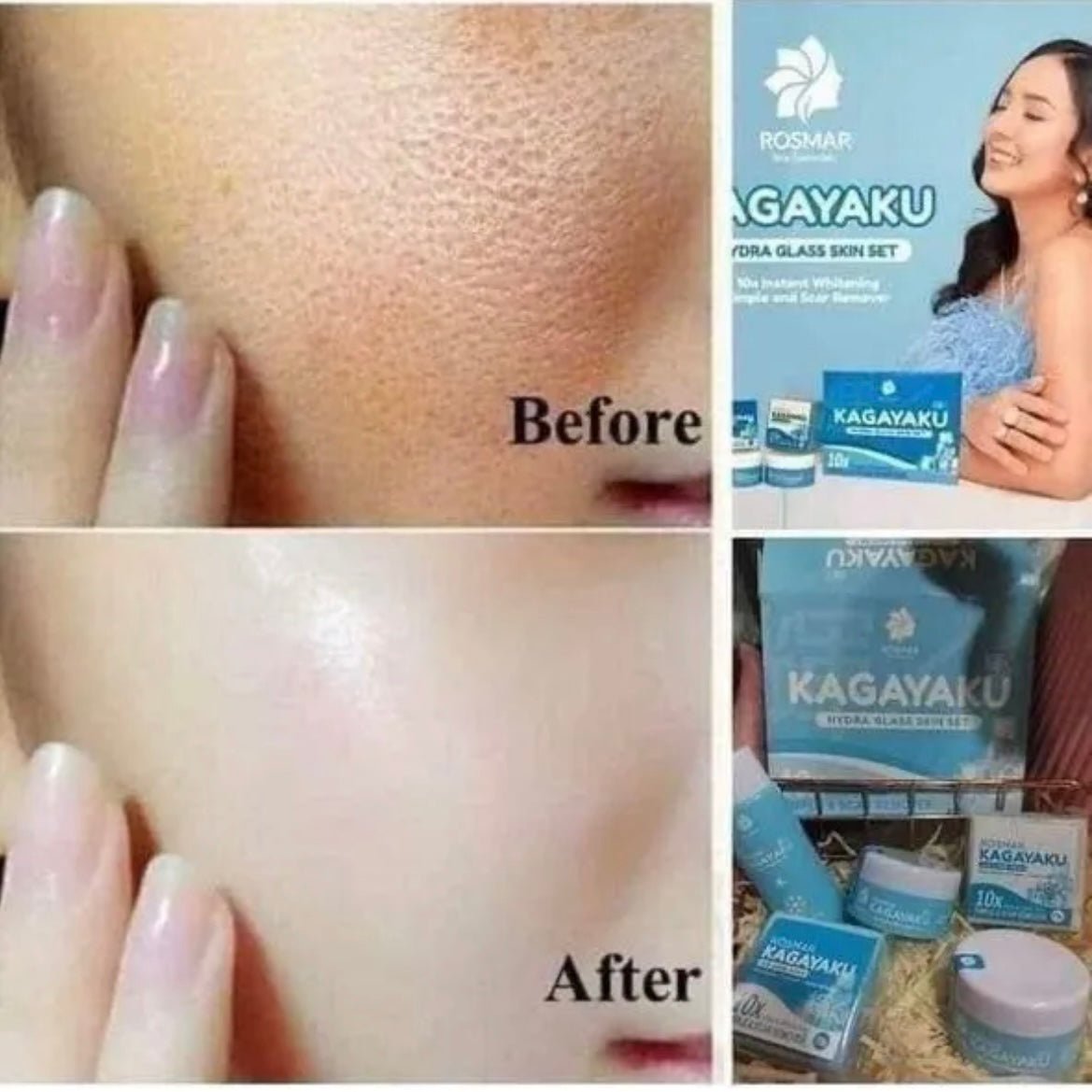 Rosmar Kagayaku Instant Whitening Pimple & Scar Remover (Hydraglass Skin Set) - Asian Online Superstore UK